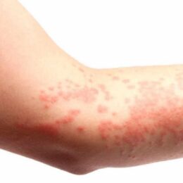 Eczéma Psoriasis